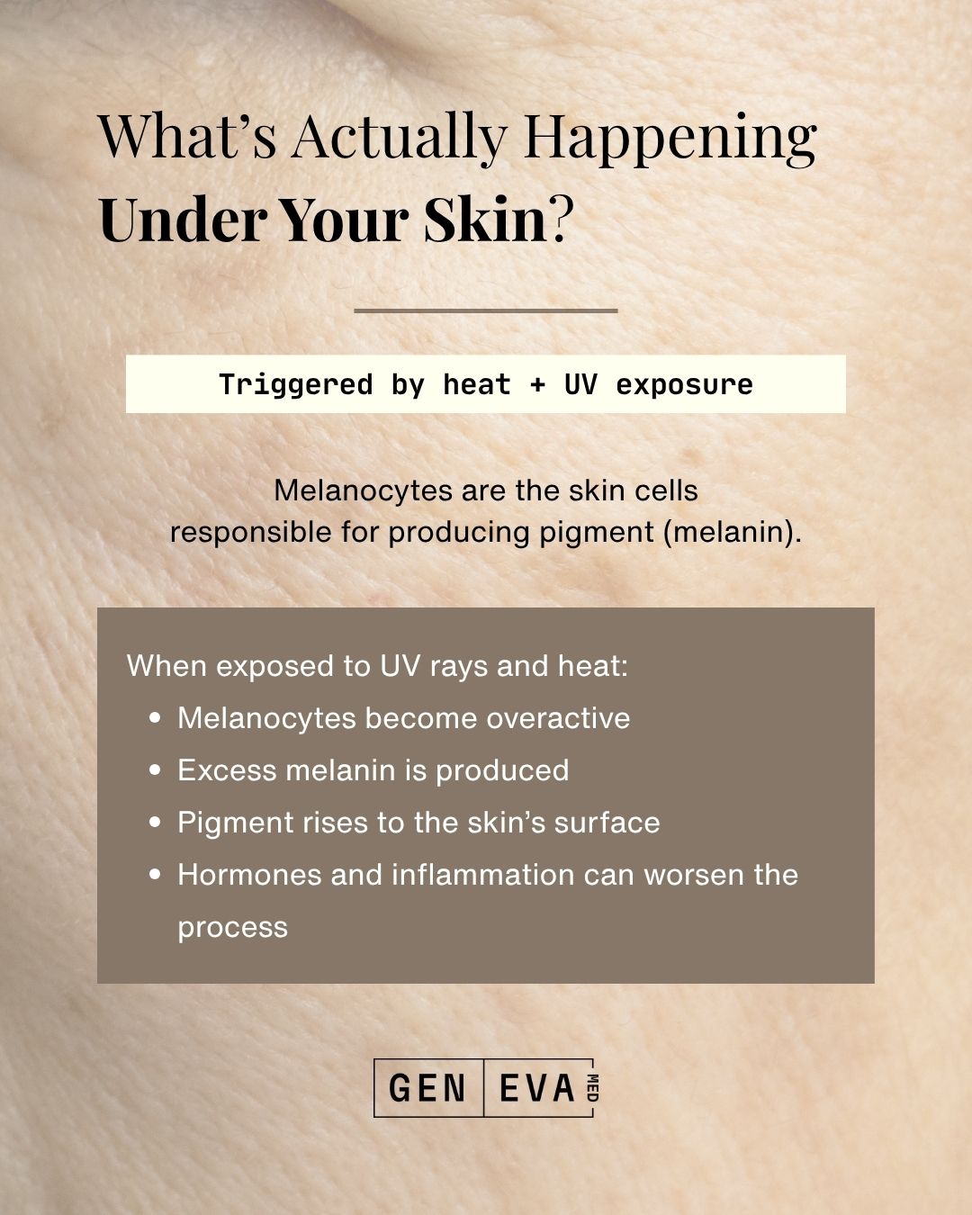 Geneva Med Instagram carousel on melasma &mdash; slide 3 of 3